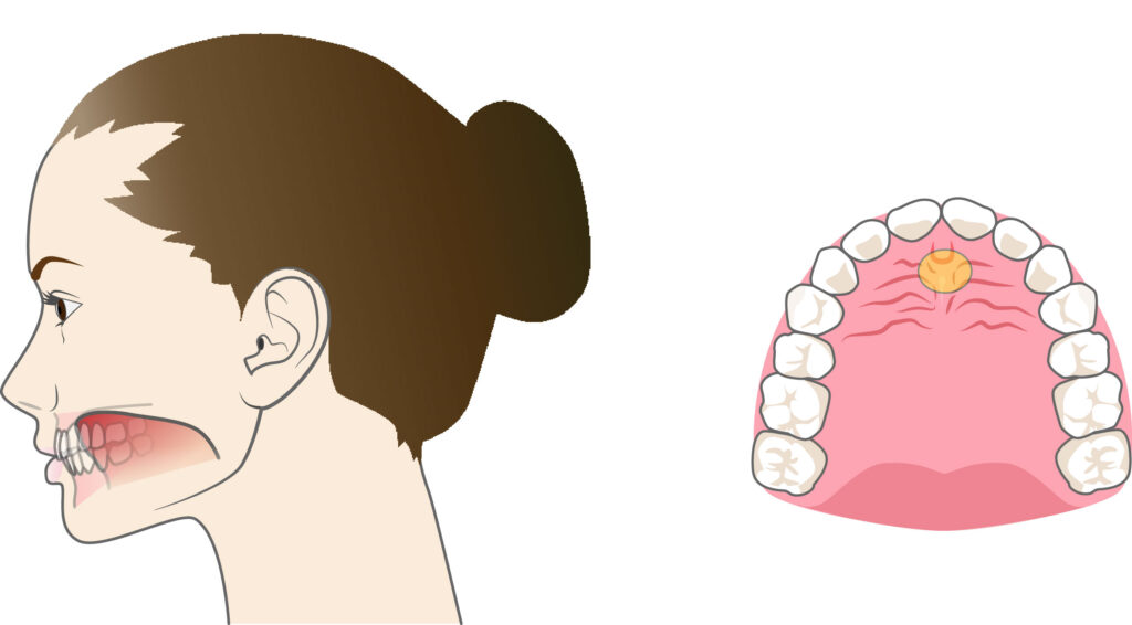 正しい舌の位置を示すイラスト