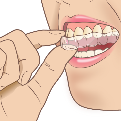 マウスピース型の矯正装置を装着するイラスト