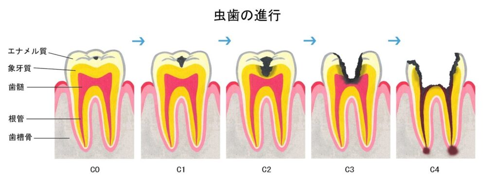 虫歯の進行度を示すイラスト