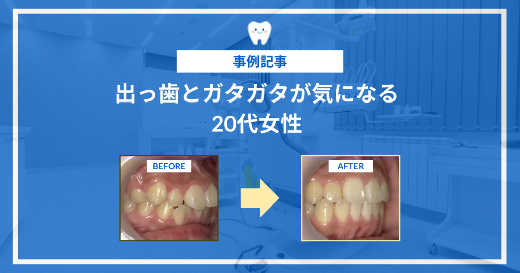 出っ歯とガタガタが気になる|20代女性事例